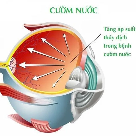 Mắt Bị Cườm Nước: Nguyên Nhân, Triệu Chứng và Cách Điều Trị 